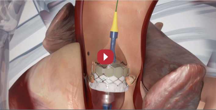 Opzioni di intervento per la sostutuzione valvolare aortica (AVR)